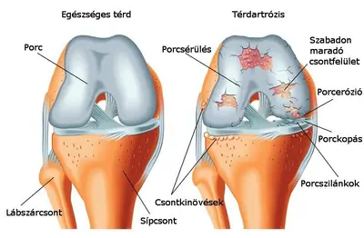 artrózis