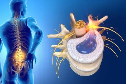 Hogyan lehet enyhíteni a gerincsérv okozta fájdalmat?