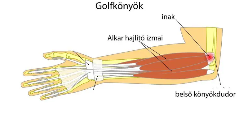 golfkönyök kezelése