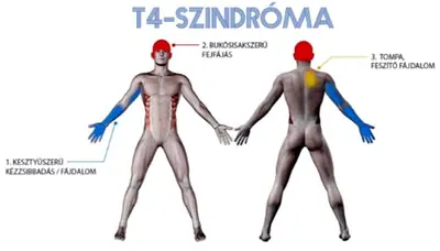 Ábra a T4-szindrómáról: két emberalak, rajtuk jelölve a zsibbadás és a fejfájás területei.
