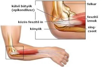 teniszkönyök kezelése